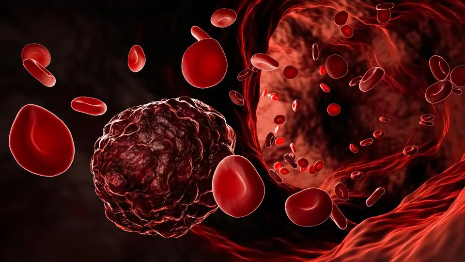 Know the early stages of blood cancer from these symptoms