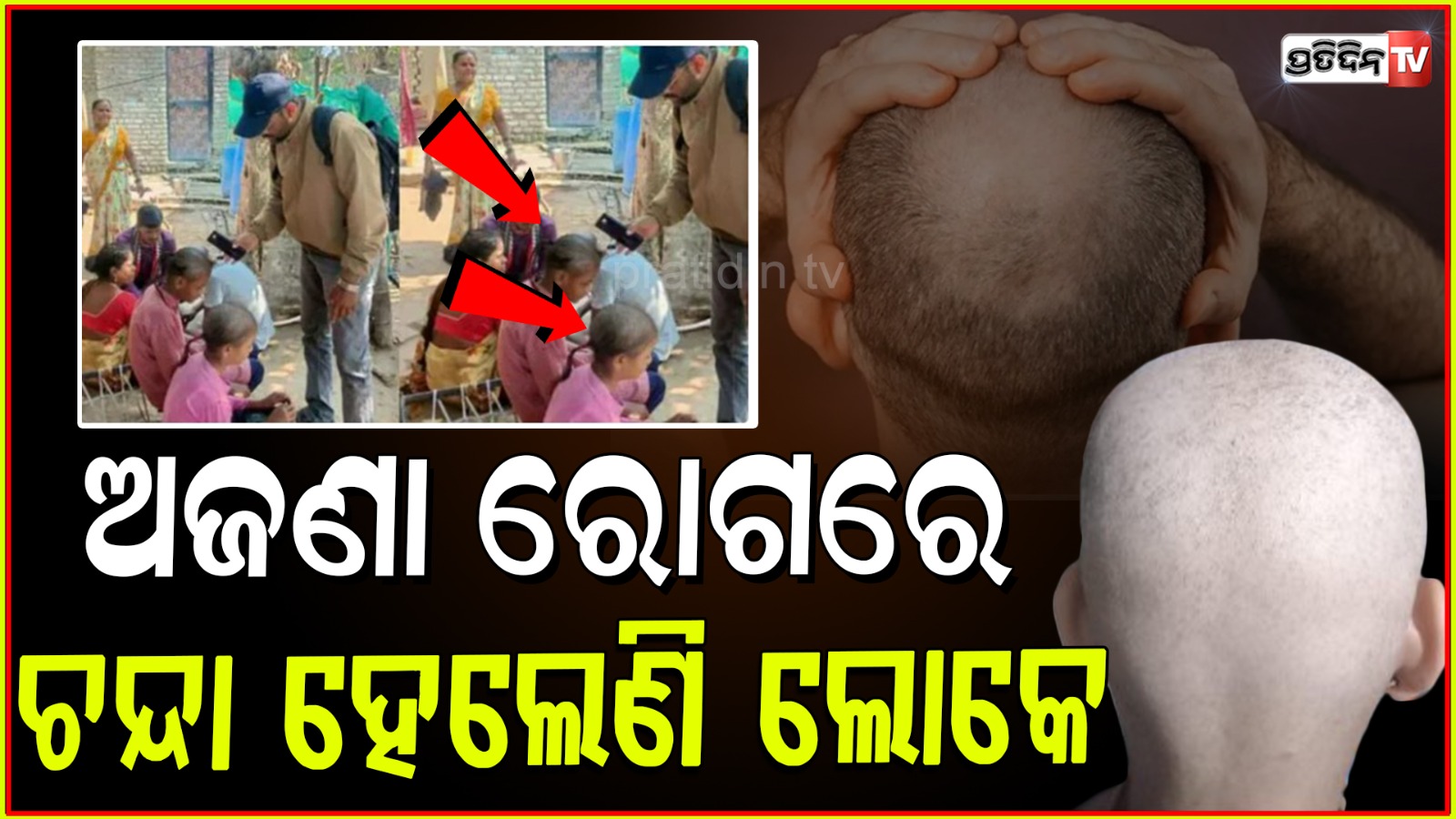 Hair loss mystery, These three villages people are becoming bald