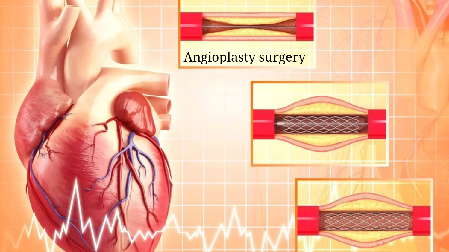 Why is Angioplasty Surgery performed?