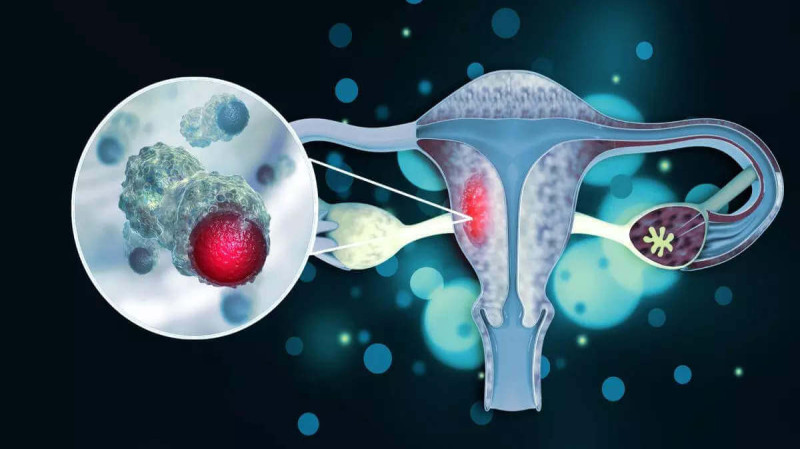 What is cervical cancer: causes, symptoms, and treatment?