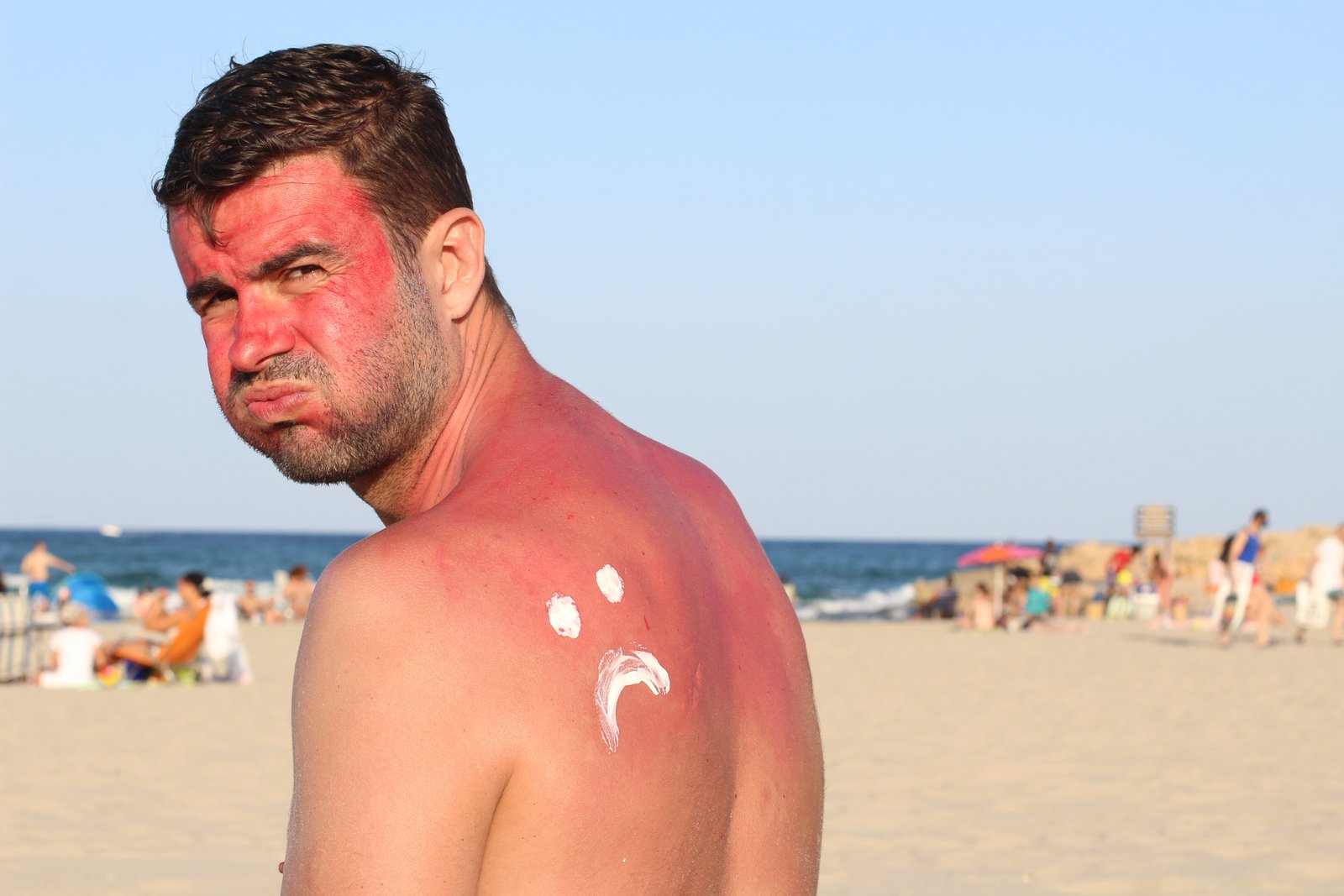 How To Get Rid Of Sunburn Naturally?