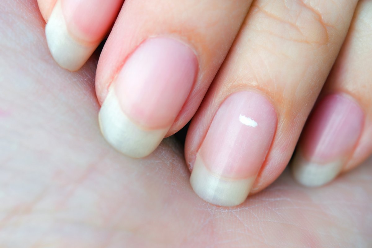 Why Do Nails Have White Spots? Know The Causes