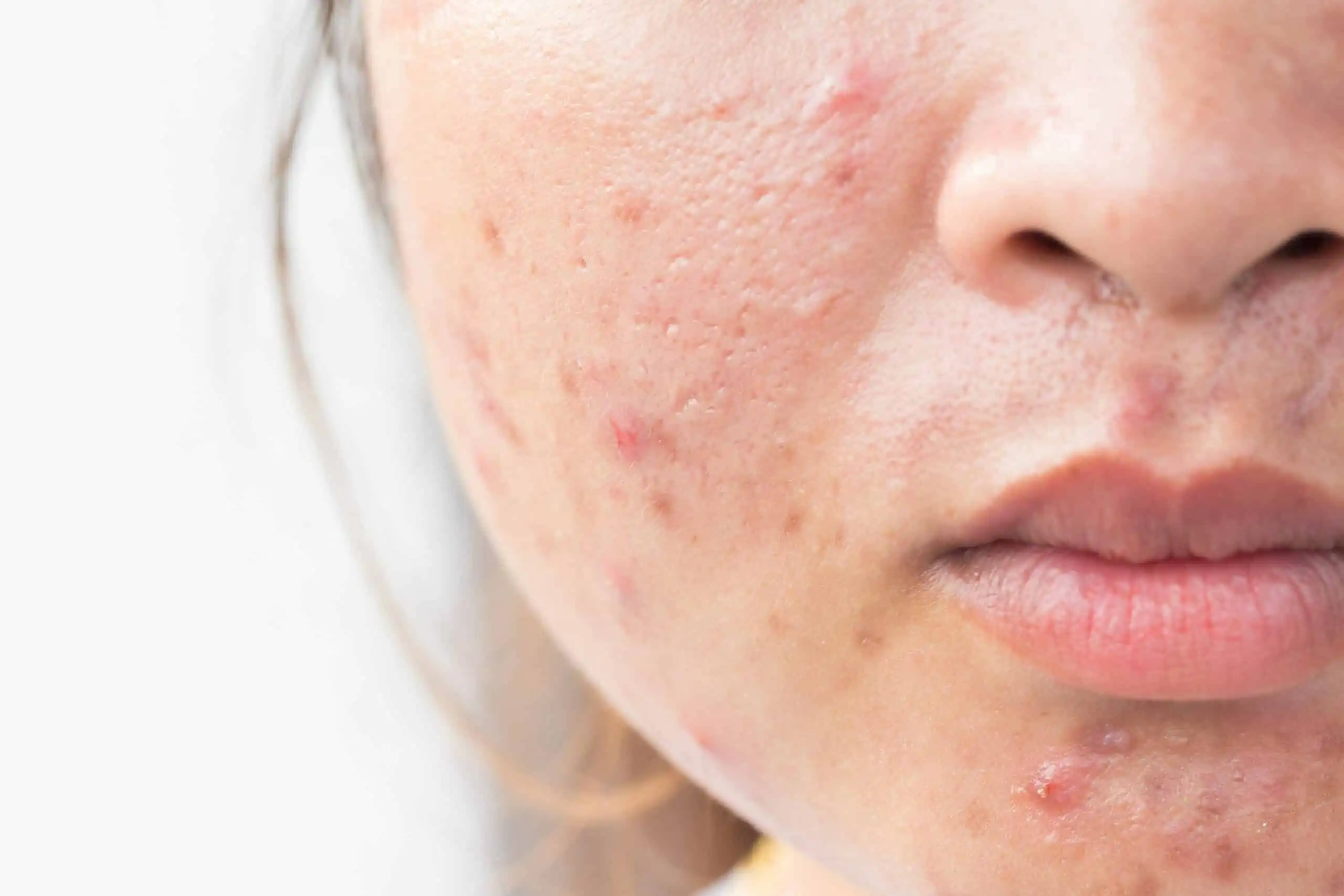 Home Remedies for Acne/ Pimple