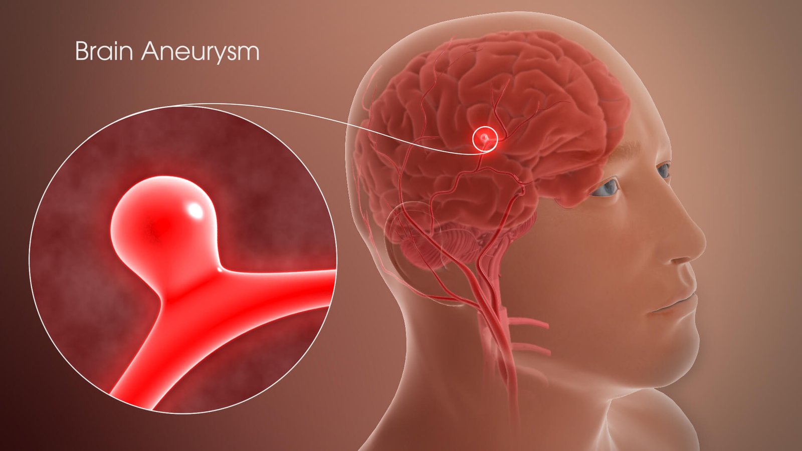Brain Aneurysm Disease: Causes And Symptoms