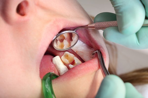 Cavities Without Fillings? How Teeth Can Repair Early Damage