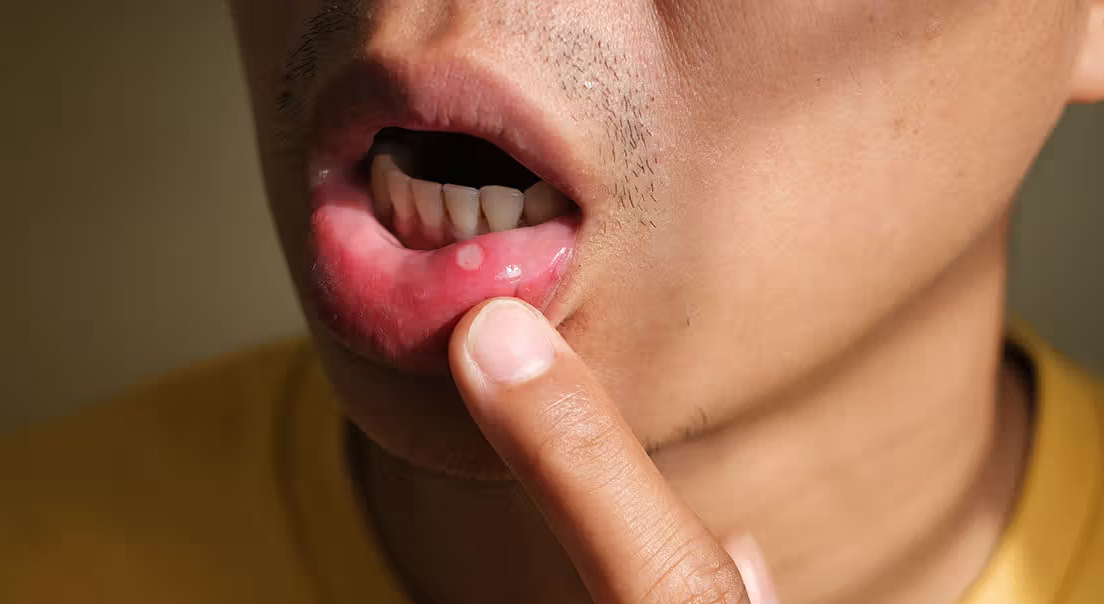 Mouth Ulcers Over Two Weeks? Early Signs of Cancer You Must Know