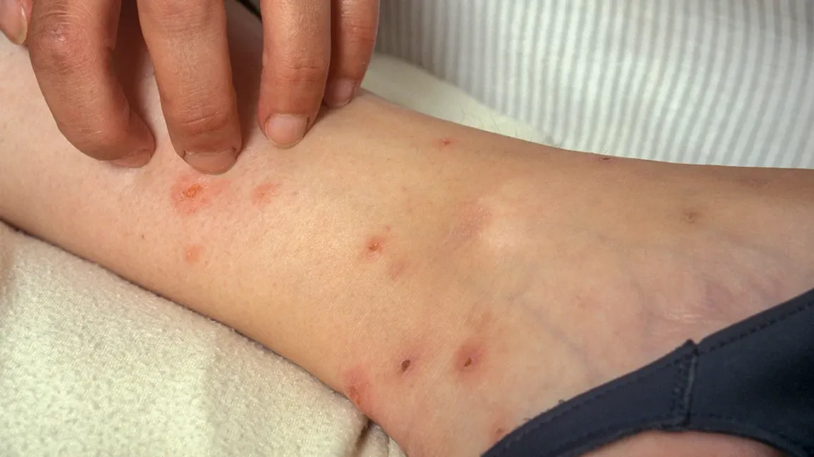 Itching in the Body Is Not Just a Skin Problem — Know the Causes and Remedies
