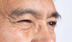 Eye Twitching: Causes, Remedies and When to See a Doctor