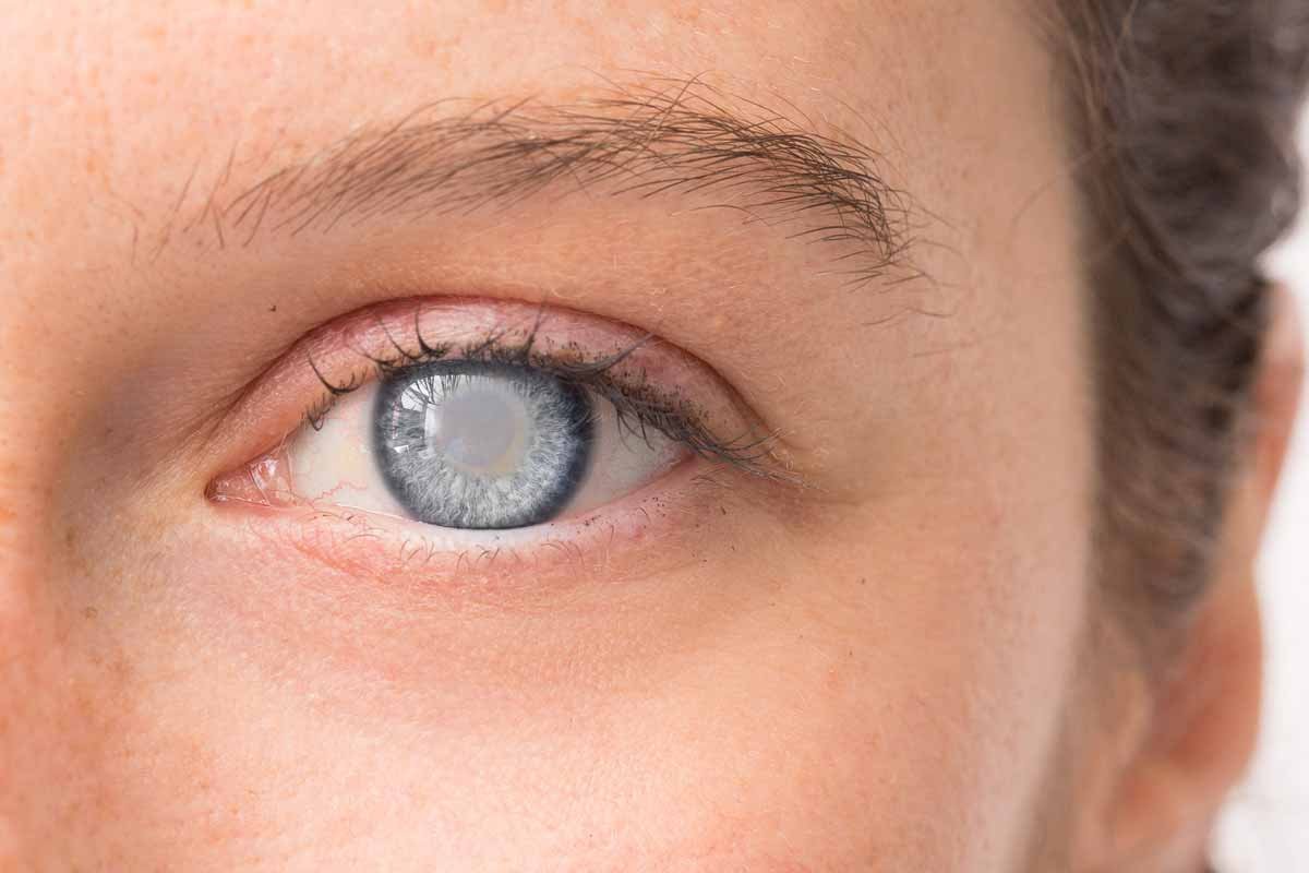 Early Signs of Cataracts: What You Should Know