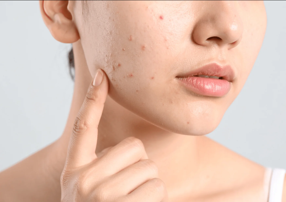 Rich moisturizers may cause ‘Summer Acne’, know what experts say